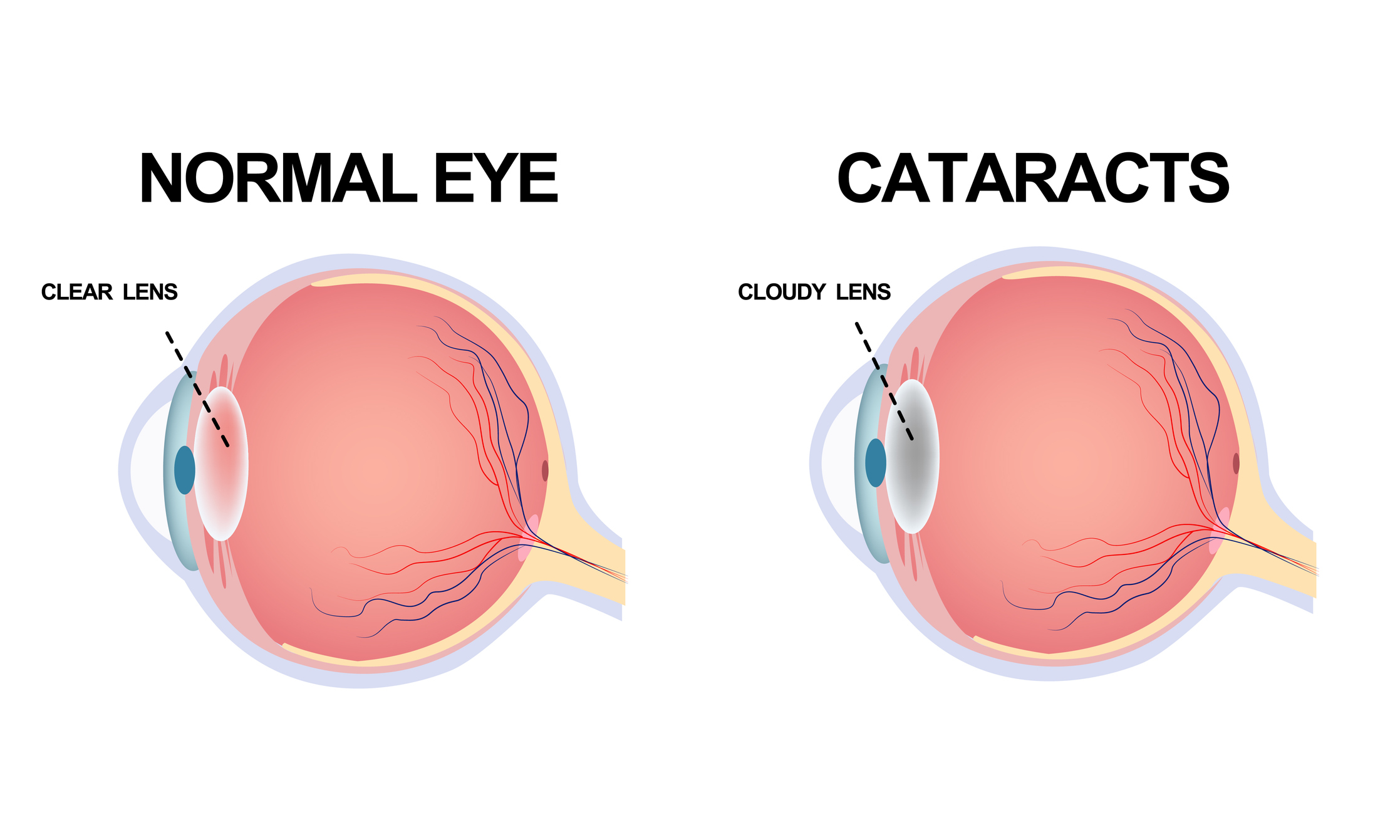 Normal Eye VS Eye with Cataracts in Atlanta