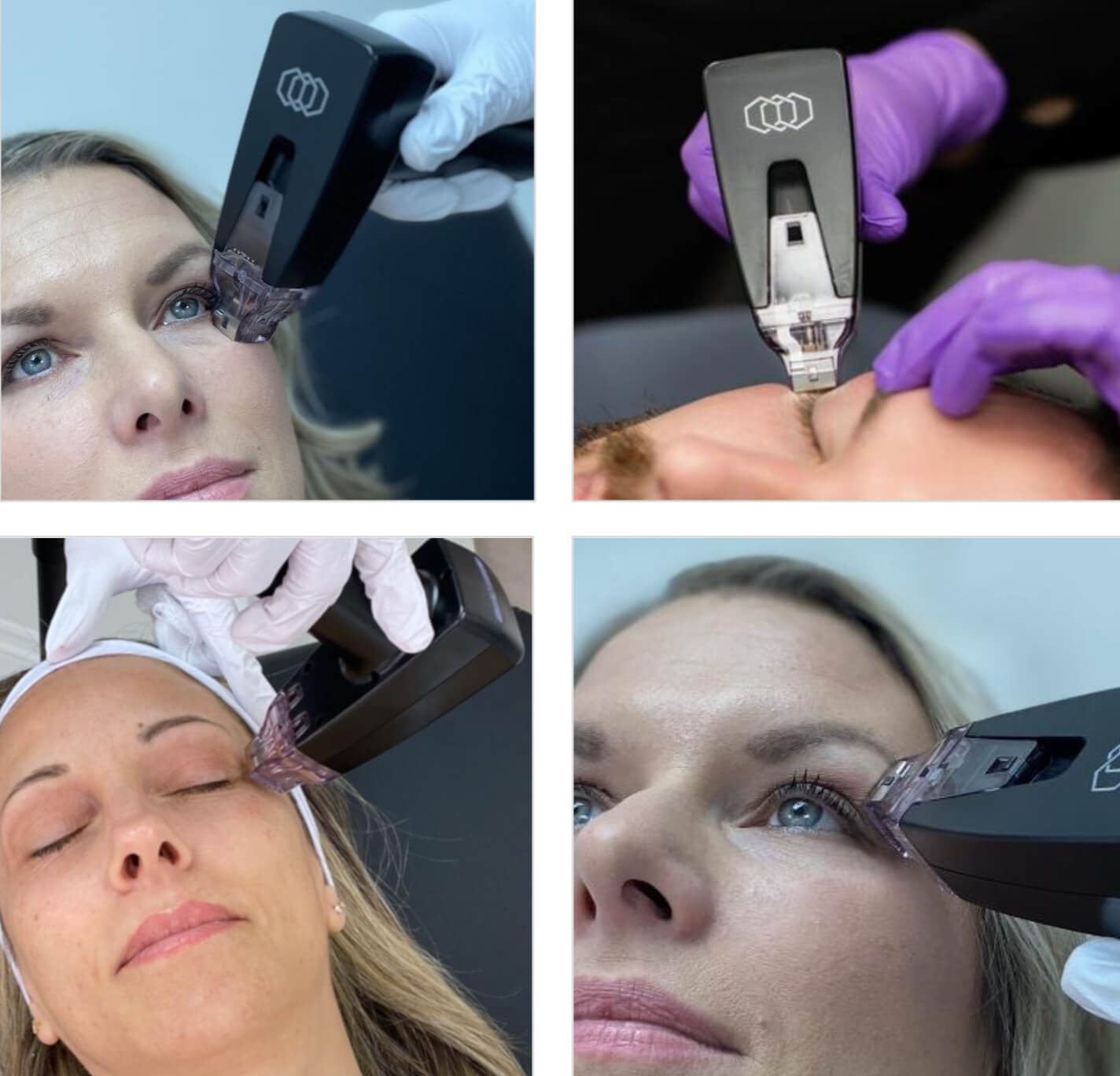 Four different before and after images after using morpheus8