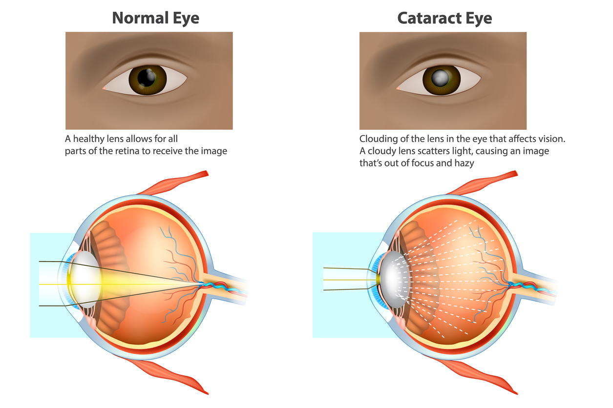 Is Cataract Surgery Necessary Blog is-cataract-surgery-necessary-blog