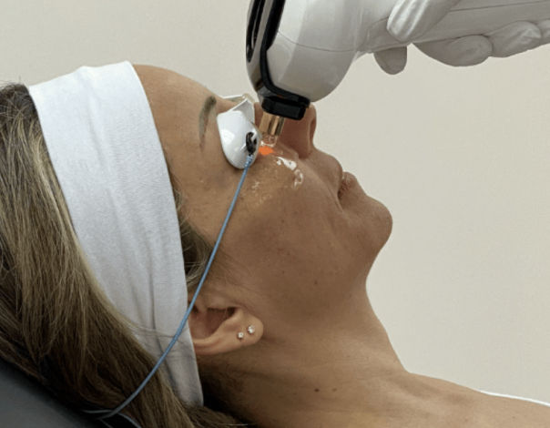 Lumecca-I Treatment Photo