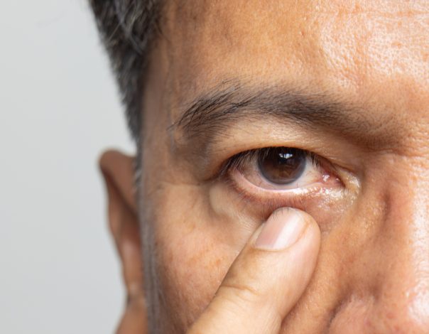 Senior man with dry eyes