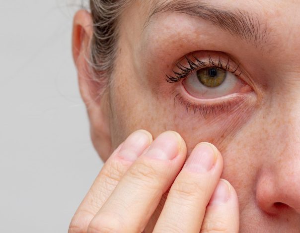woman with dry eye