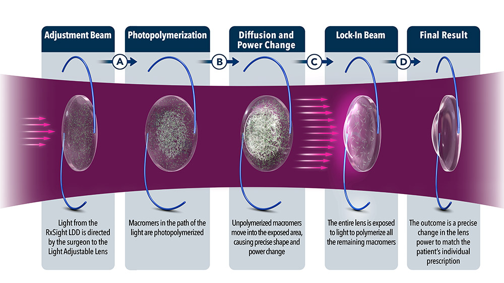 Light Adjustable Lens (LAL) Georgia