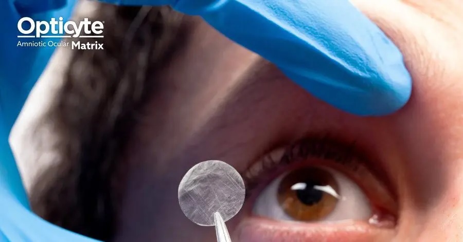 Amniotic Membrane Treatment in Atlanta, GA